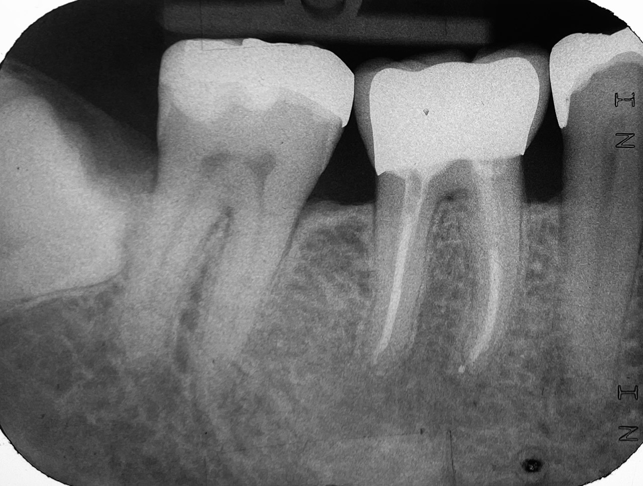 Endodontie/Wurzelbehandlung 02
