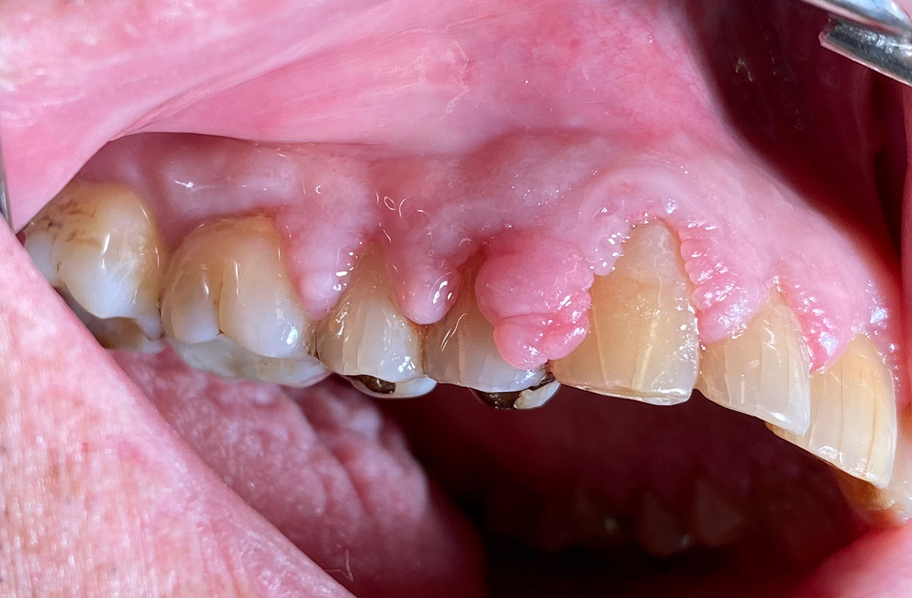Parodontologie/Gingivahyperplasie 02