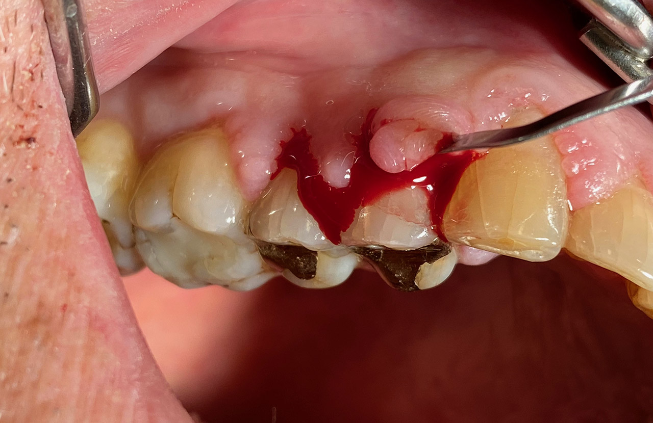 Parodontologie/Gingivahyperplasie 04