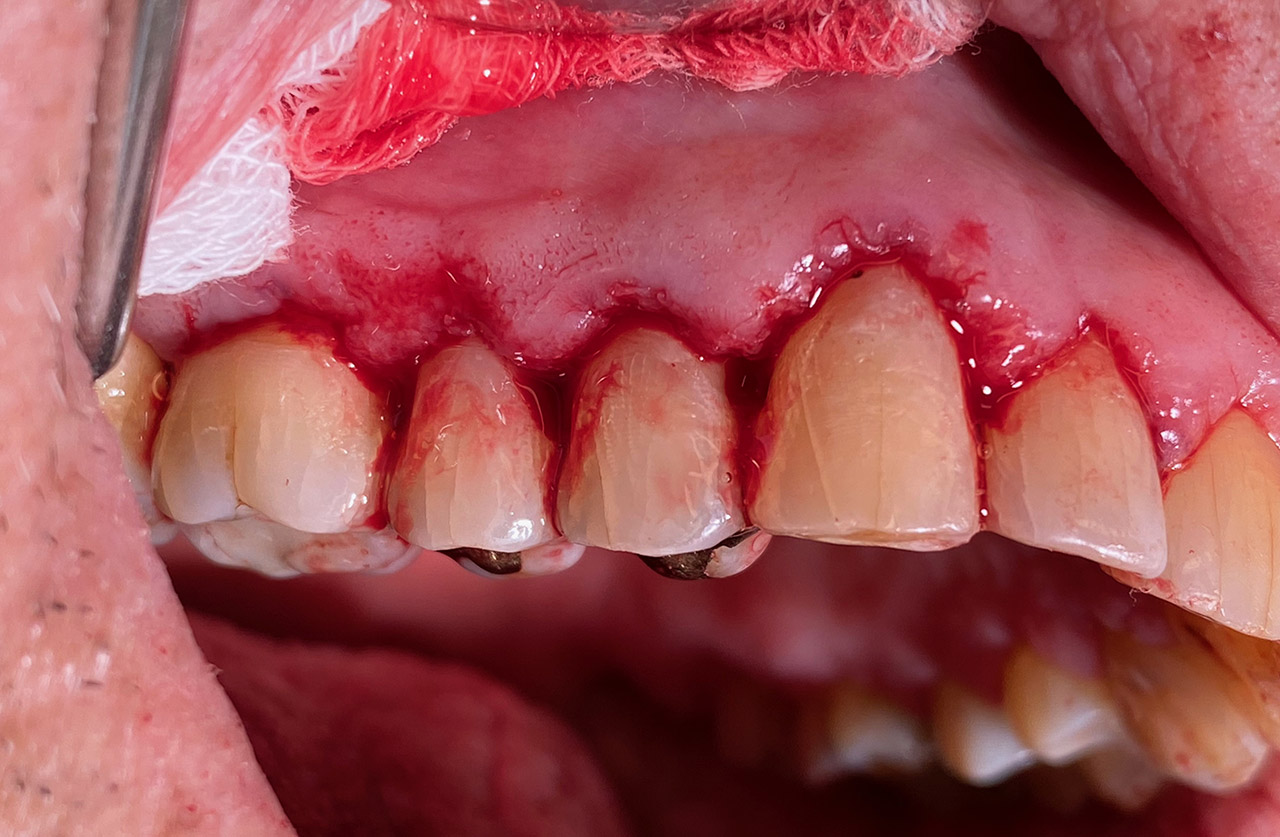 Parodontologie/Gingivahyperplasie 05