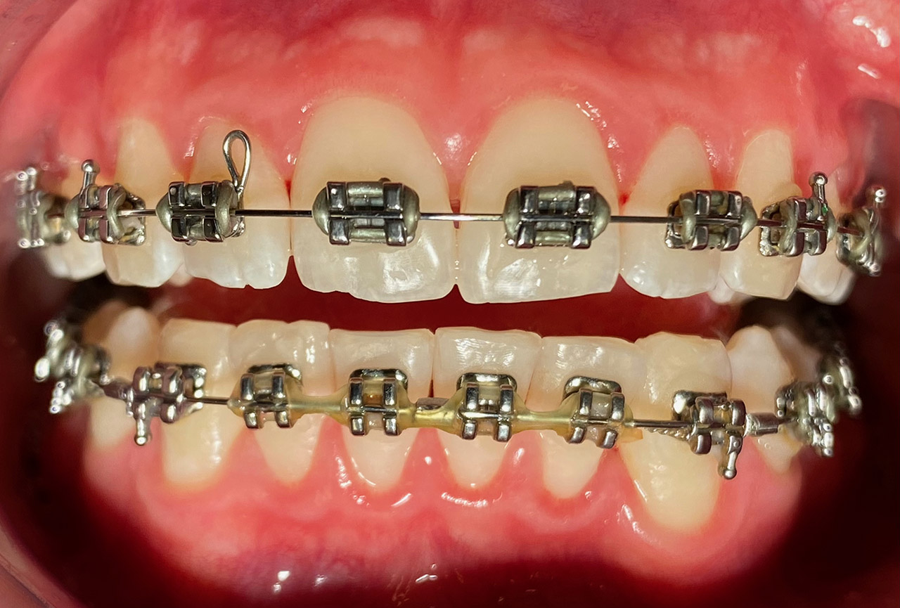 Prophylaxe/professionelle Zahnreinigung 02