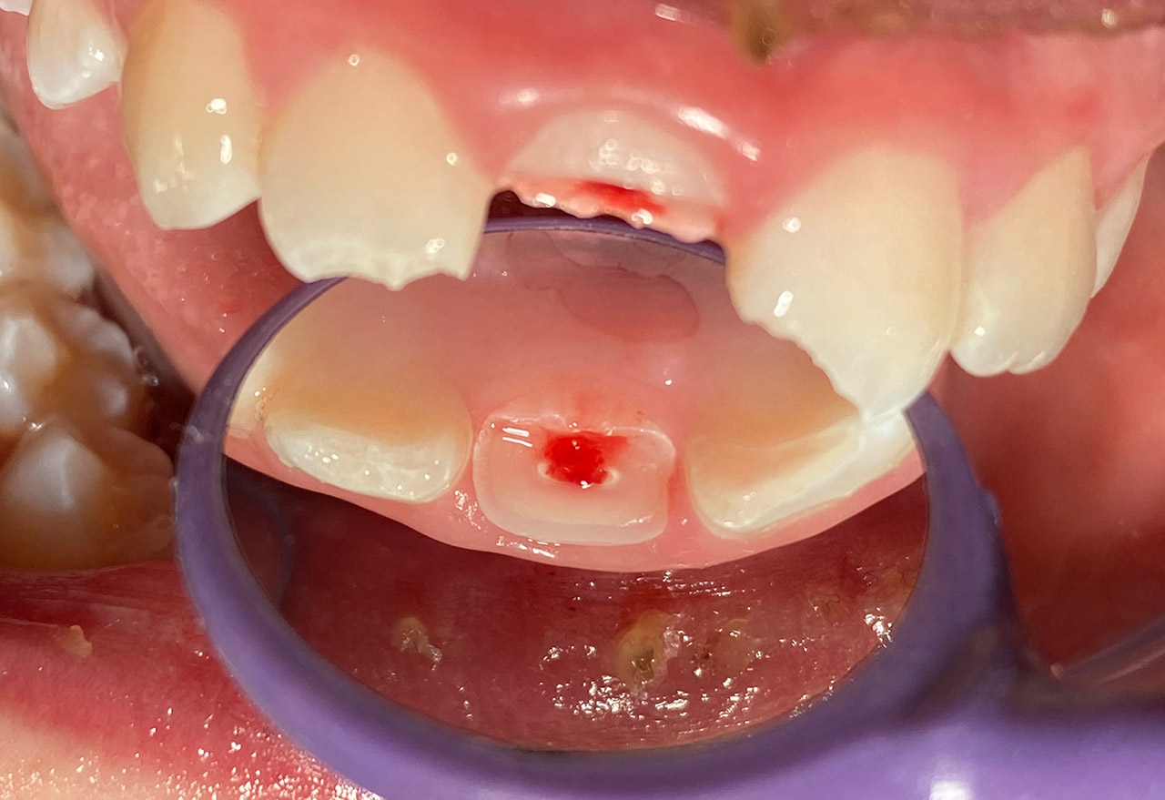 Traumatologie und Endodontie 02