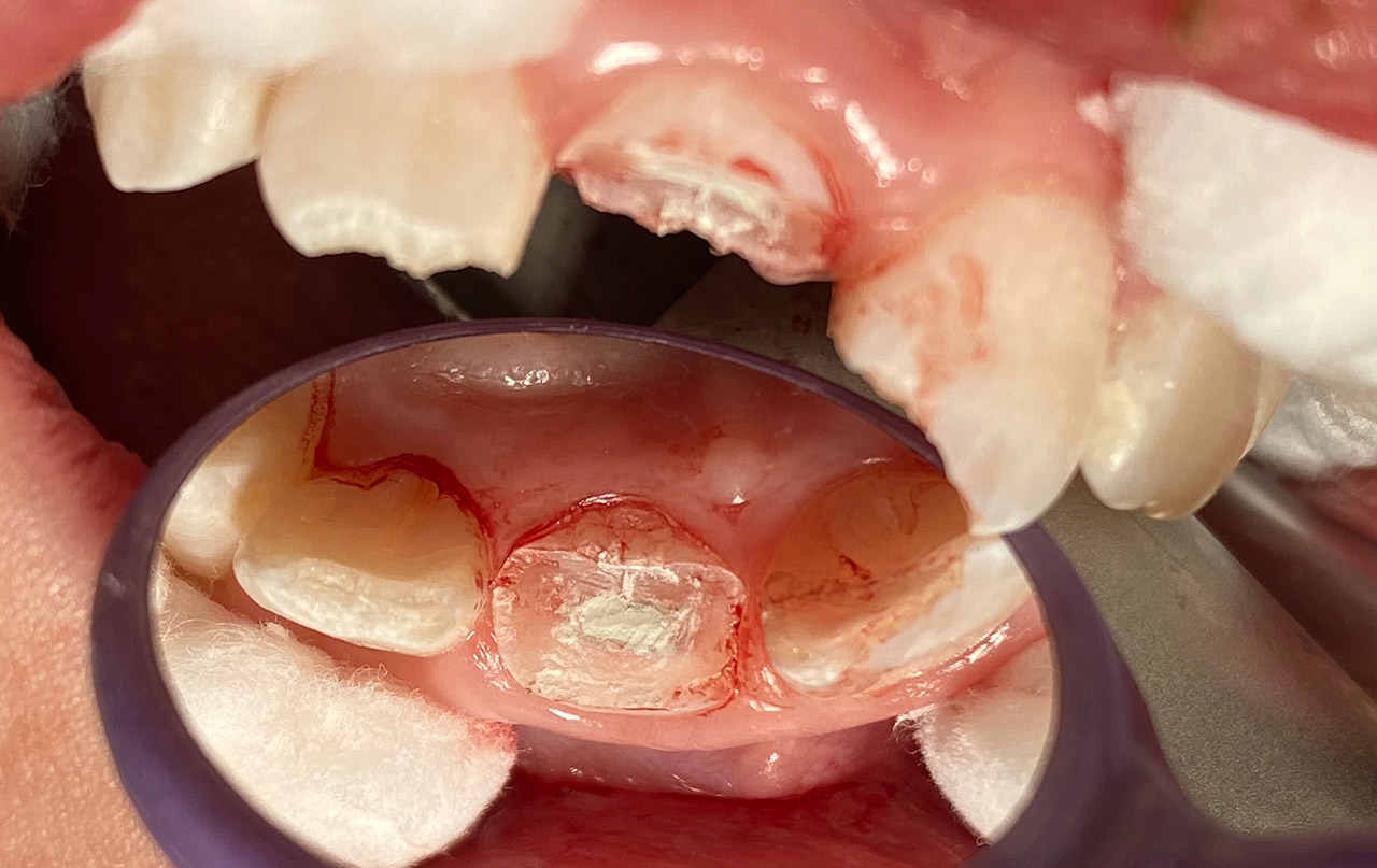 Traumatologie und Endodontie 03