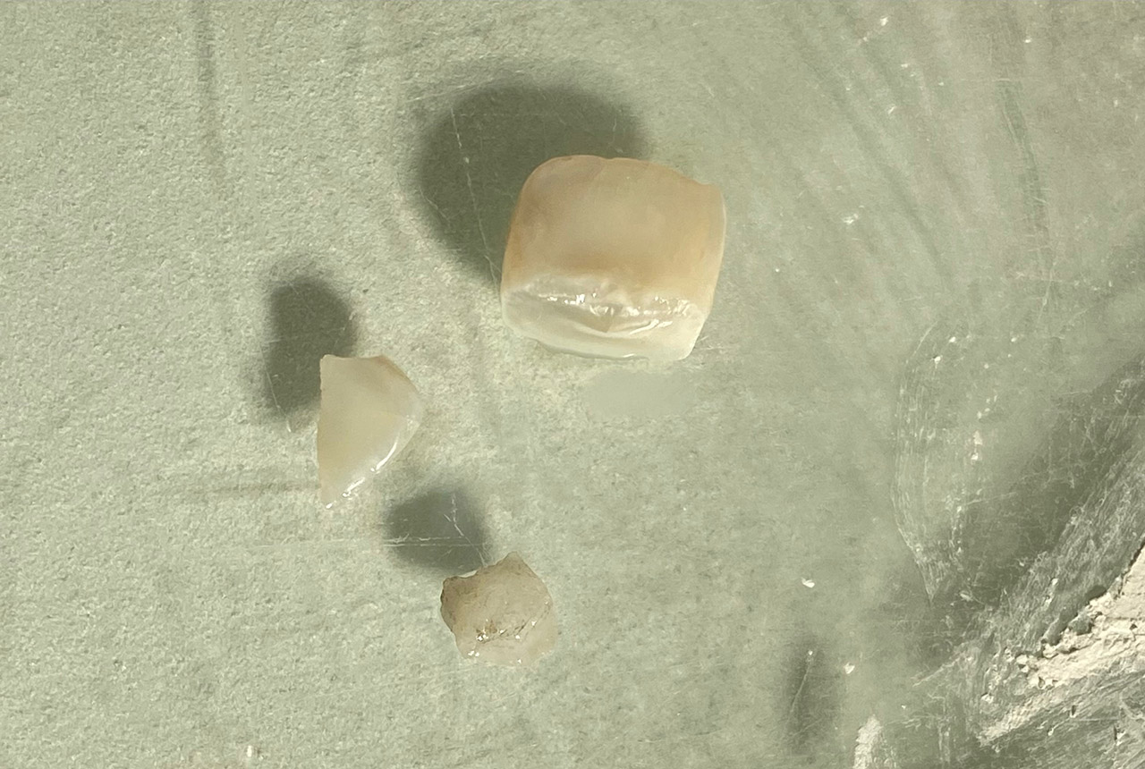 Traumatologie und Endodontie 04