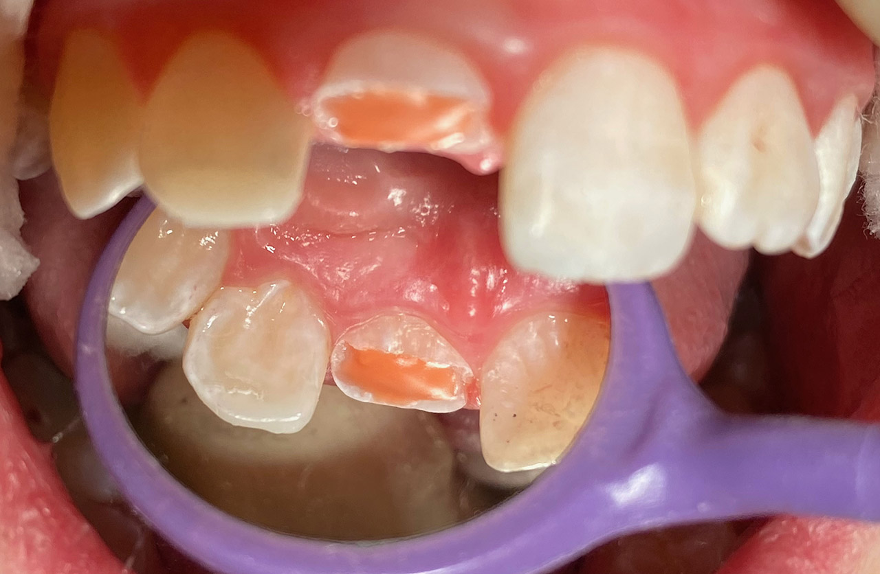 Traumatologie und Endodontie 07