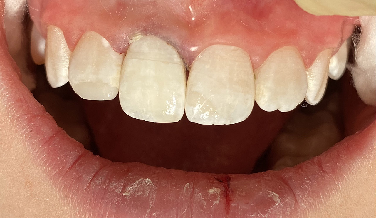 Traumatologie und Endodontie 08